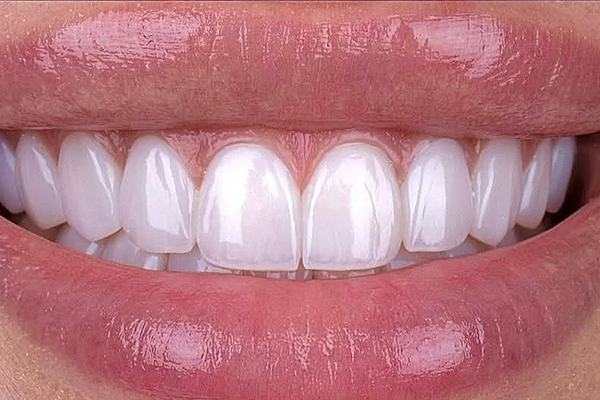 Hollywood_Smile_After_puremed