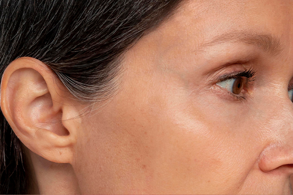 skin_after_puremed