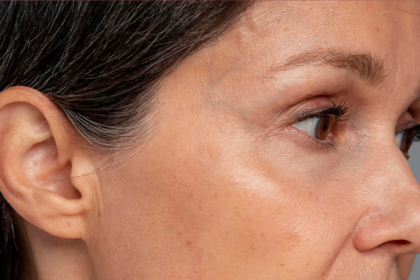 skin_before_puremed